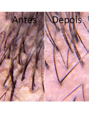 L'Oréal Scalp Advanced Anti-caspa Shampoo 300 ml